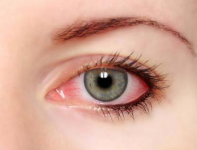 眼睛常有红血丝怎么办,来点越橘叶黄素养护眼睛